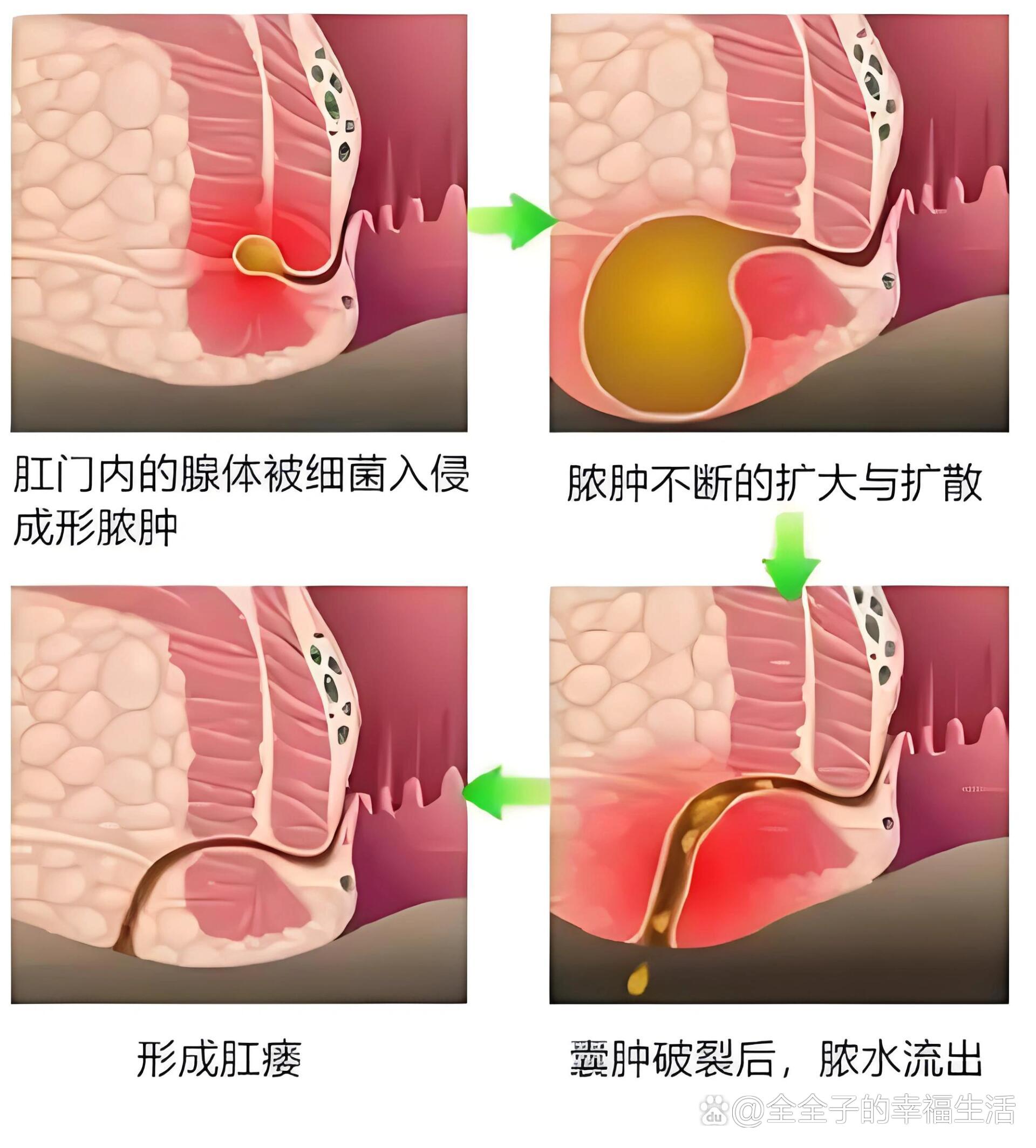 肛周脓肿最新手术方法解析与探索